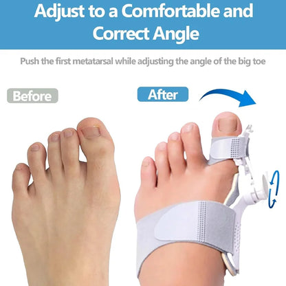 AlignToe Bunion Corrector for Women & Men
